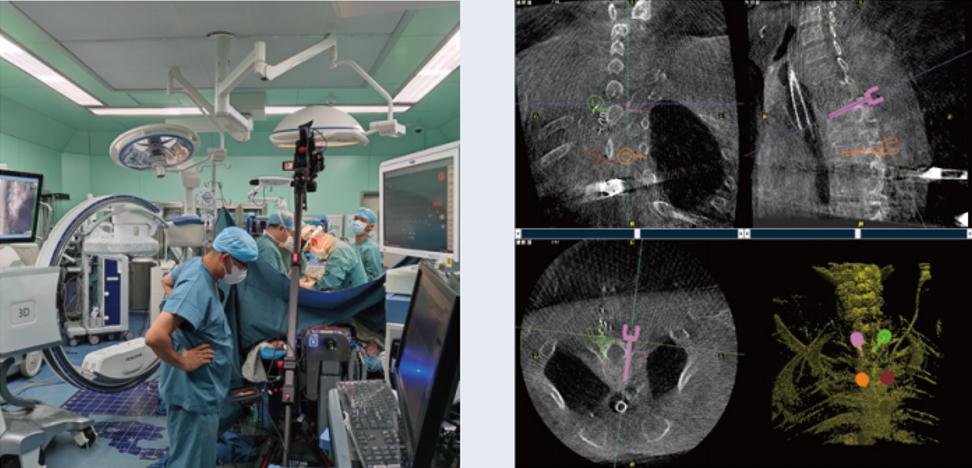 三維C臂與骨科導航機器人配合應用(助力骨科手術更準確)