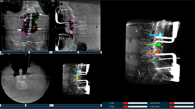 機器人輔助腰椎后路側彎矯形手術三維圖像